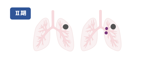 ステージ2の肺の例（イラスト）